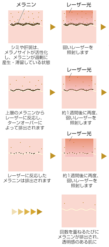 低出力で炎症が起こりにくい