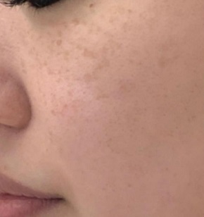 レーザートーニング施術前