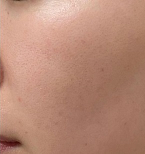 レーザートーニング施術後